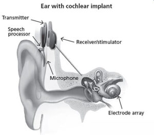 Discover How Cochlear Implants Restore Sound